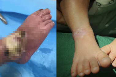 Bé gái bị đèn trị vàng da làm bỏng nặng hồi phục ngoạn mục nhờ tế bào gốc