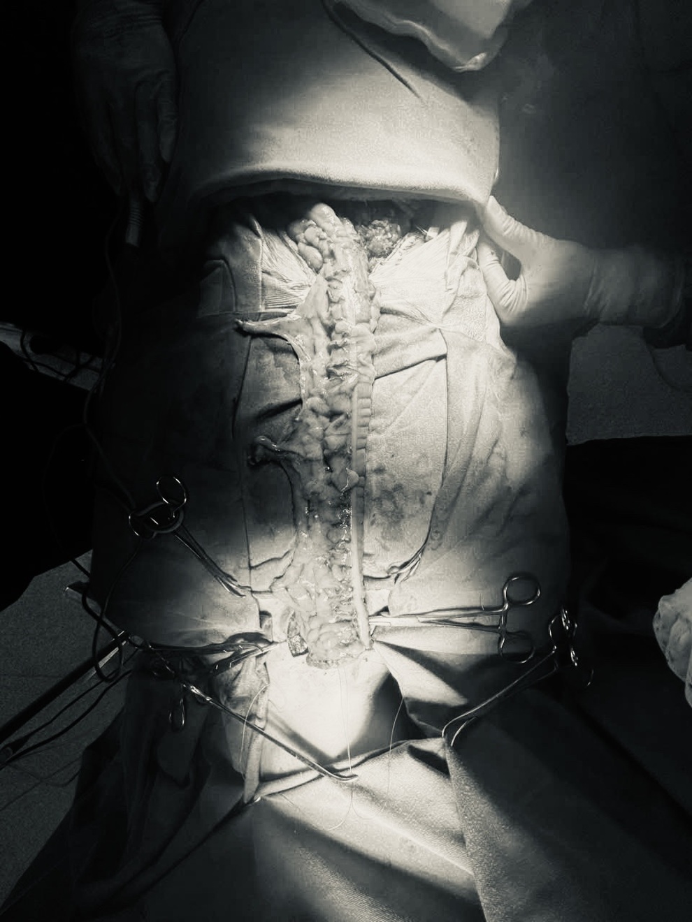 Spezialchirurgie: Speiseröhrenersatz durch Dickdarm bei Krebspatienten - 2 Ca mổ đặc biệt: Dùng đại tràng thay thực quản cho bệnh nhân ung thư - 2