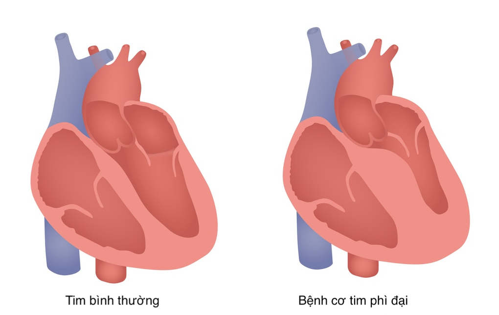 Bơm cồn sinh học cứu sống bệnh nhân bị bệnh cơ tim phì đại nặng - 2 Bơm cồn sinh học cứu sống bệnh nhân bị bệnh cơ tim phì đại nặng - 2