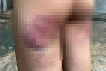 Không làm được bài tập, bé gái lớp 4 bị cô giáo đánh bầm tím mông