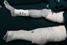 Người đàn ông 33 tuổi bị máy cuốn vải làm đứt lìa chân