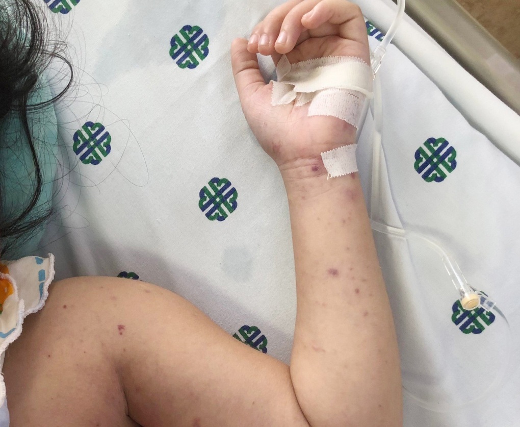 Không thiếu vaccine phòng bệnh não mô cầu cho trẻ em và người lớn - 1 Không thiếu vaccine phòng bệnh não mô cầu cho trẻ em và người lớn - 1