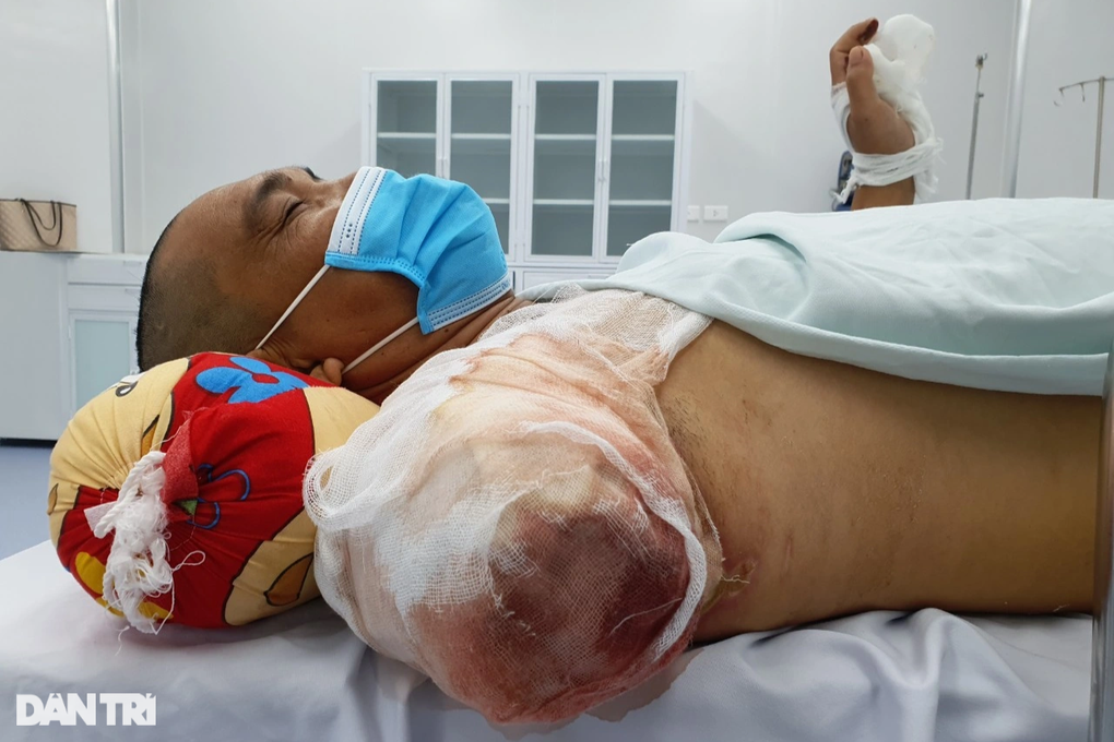 Bỏng điện cao thế, người đàn ông trụ cột gia đình phải cắt cụt tay, chân - 3