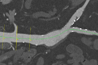 Phối hợp liên viện cứu cụ ông bị phình bóc tách động mạch chủ
