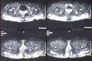Vùng mông lổn nhổn hàng trăm u cục chỉ vì tiêm mỡ nhân tạo tại spa