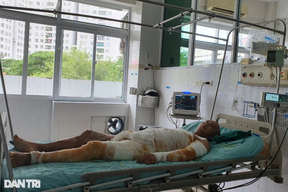 Thương người đàn ông cháy như bó đuốc sau cú phóng điện cao thế oan nghiệt - 2 Thương người đàn ông cháy như bó đuốc sau cú phóng điện cao thế oan nghiệt - 2