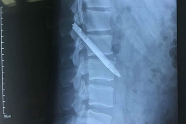 Chiến sỹ công an 11 năm sống chung với lưỡi dao găm nằm gần cột sống