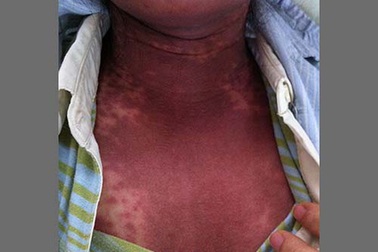 Dị ứng thuốc ngày càng đáng sợ!