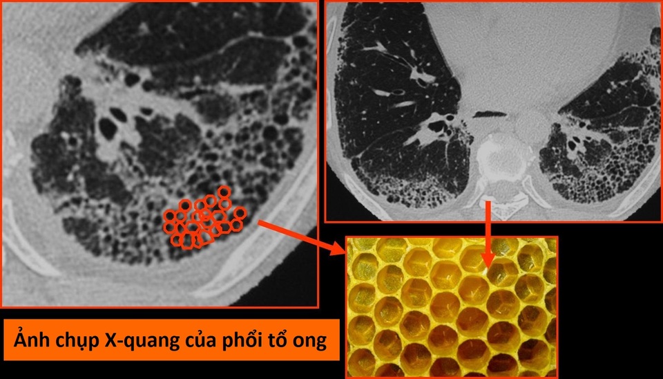 Virus corona mới tàn phá các bộ phận trên cơ thể như thế nào? - 3 Virus corona mới tàn phá các bộ phận trên cơ thể như thế nào? - 3