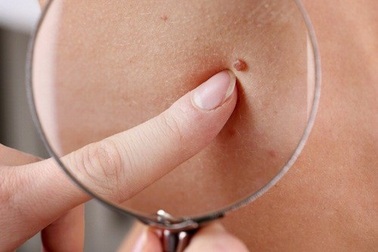 Nguyên nhân chủ yếu gây bệnh ung thư da