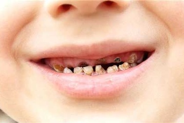 90% dân số Việt gặp các vấn đề về răng miệng