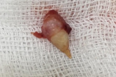 Hi hữu: Răng mọc trong mũi của bé gái 4 tuổi