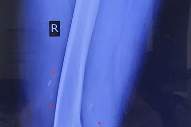 Sán chi chít trong người vì món cá đặc sản
