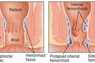Điều trị bệnh trĩ bằng dược liệu 