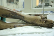 Hà Nội: Người đàn ông sốt cao rồi tử vong vì mầm bệnh nguy hiểm từ lợn