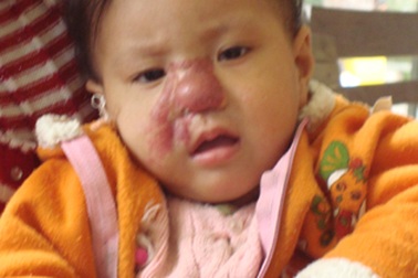 Cô bé bị u máu vùng mặt 
