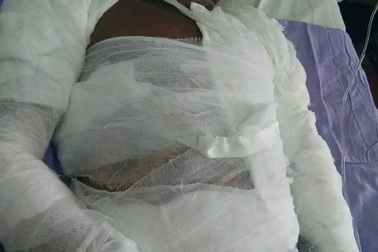 Chồng bỏng nặng vì bị vợ tạt nước sôi