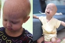 Căn bệnh cực hiếm và nguy hiểm ở trẻ em, cả Việt Nam mới phát hiện 2 ca mắc