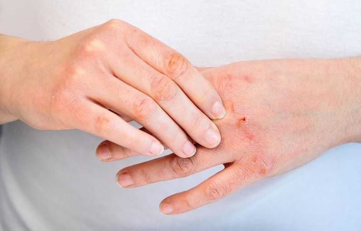 Sự kết hợp Đông - Tây y: Lựa chọn cho bệnh viêm da cơ địa - 1 Sự kết hợp Đông - Tây y: Lựa chọn cho bệnh viêm da cơ địa - 1