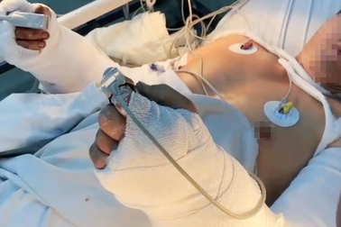 Đồng nghiệp bật máy cắt sắt khi đang sửa, người đàn ông đứt lìa 2 bàn tay