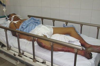 Gần 60% bệnh nhân mắc liên cầu khuẩn lợn có ăn tiết canh