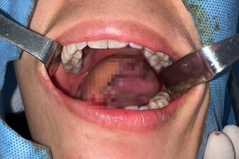 Cô gái bất ngờ phát hiện ung thư lưỡi giai đoạn muộn, phải cắt gần hết lưỡi