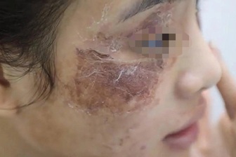 Cô gái gặp "họa" vì thoa kem mua trên mạng giá 600.000 đồng