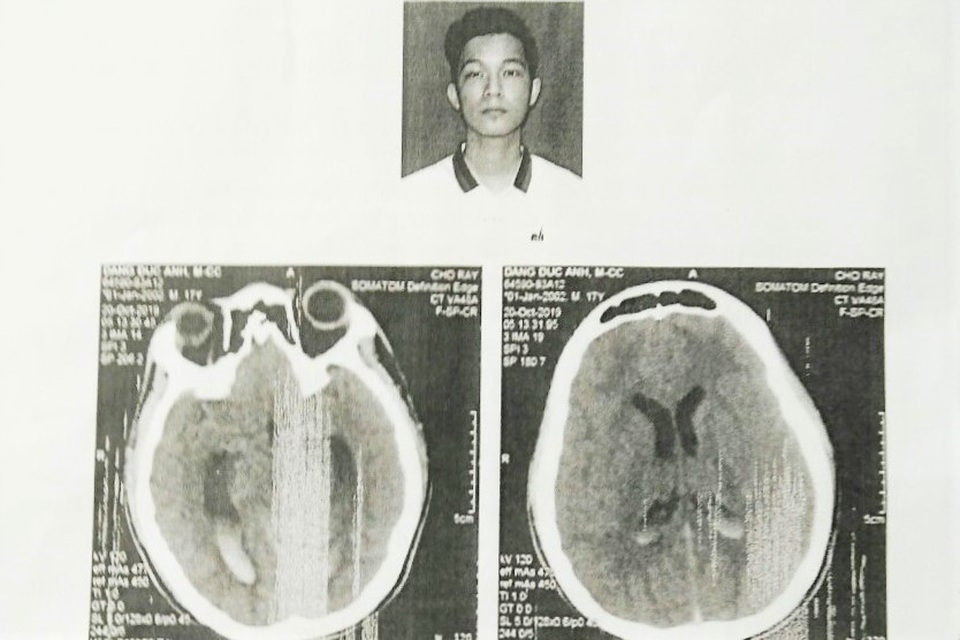 Bạc Liêu: Khởi tố một bị can vụ nam sinh bị đánh chấn thương não - 1 Bạc Liêu: Khởi tố một bị can vụ nam sinh bị đánh chấn thương não - 1