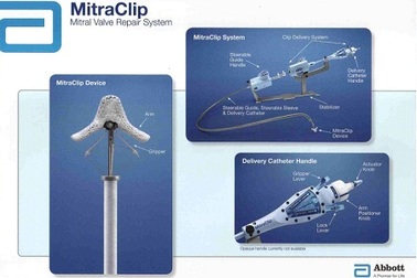 Niềm hy vọng cho người mắc bệnh hở van tim 2 lá