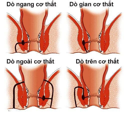 Rò hậu môn