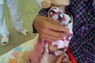 Bé 3 tuổi tử vong vì suy kiệt nặng sau khi chữa bỏng thầy lang