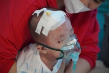 Hà Nội gia tăng bệnh sởi, nhiều trẻ thở oxy chỉ sau vài ngày nổi ban