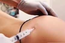 Cô gái phải nạo nhiều ổ mủ sau tiêm filler nâng cấp vòng 3