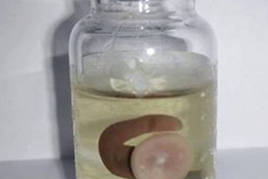 Vắt dài 3cm chui lên mũi bệnh nhân