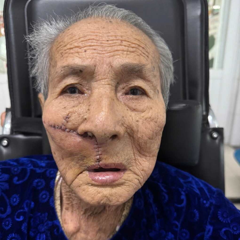 얼굴에 생긴 작은 점이 3년 만에 종양으로 발전해 구더기가 둥지를 틀었다 - 2 Từ nốt ruồi nhỏ trên mặt, sau 3 năm phát triển thành khối u, giòi làm tổ - 2