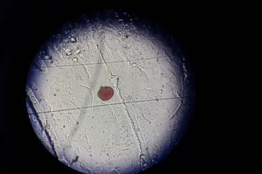 Rận mu ký sinh ở nách người đàn ông suốt hai tháng