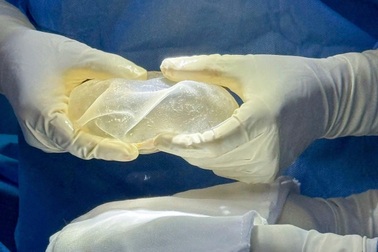 Ngực sa trễ và những nguy cơ tiềm ẩn trong tạo hình thẩm mỹ