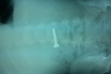 Quảng Bình: Bé 3 tuổi nuốt đinh vít vào bụng