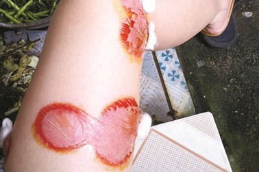 Bọ xít hút máu lại tấn công