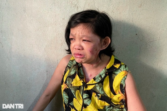 Người mẹ góa chết đứng khi con gái ngã vào nồi bánh tráng sôi sùng sục - 2