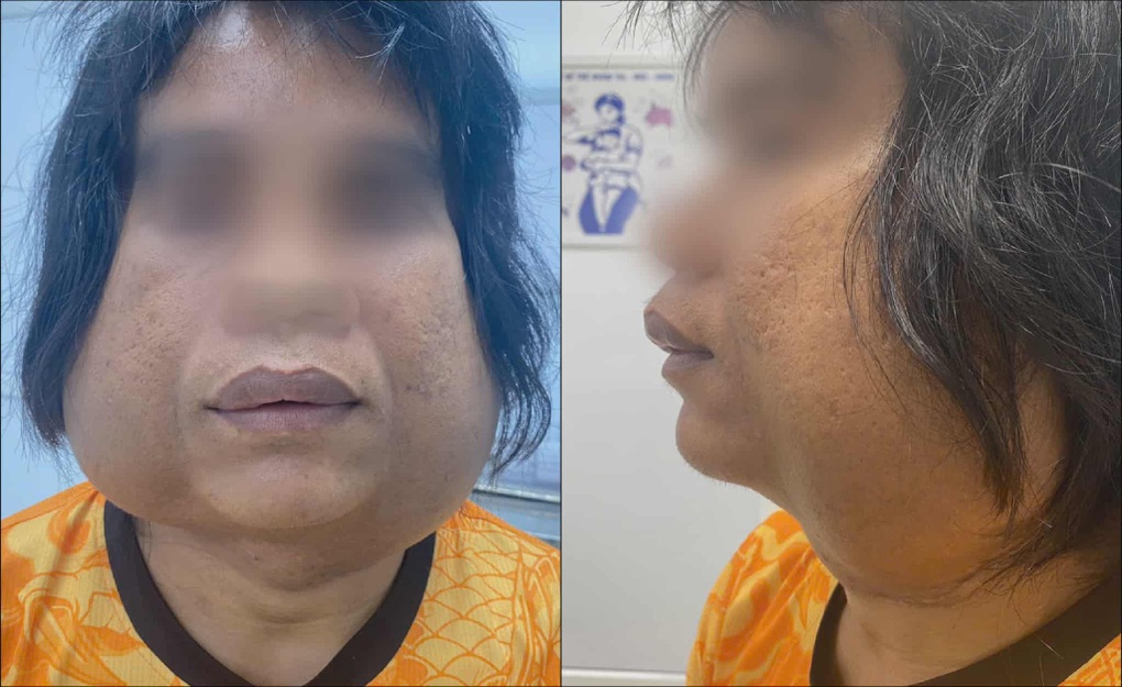 Chàng trai 10 năm mang 2 khối u lạ, mổ xong lại mọc lên và phình to - 1 Chàng trai 10 năm mang 2 khối u lạ, mổ xong lại mọc lên và phình to - 1
