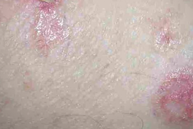 Dày sừng ánh nắng - Dấu hiệu ung thư da do ánh nắng mặt trời