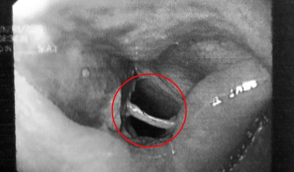  Cụ bà bị xương cá đâm xuyên ngang khí quản - 1