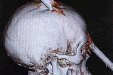 Thoát chết kỳ diệu khi bị thanh sắt xuyên qua đầu