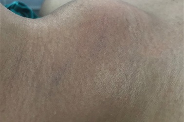 Tiên lượng kém khi ung thư tuyến giáp xâm lấn rộng