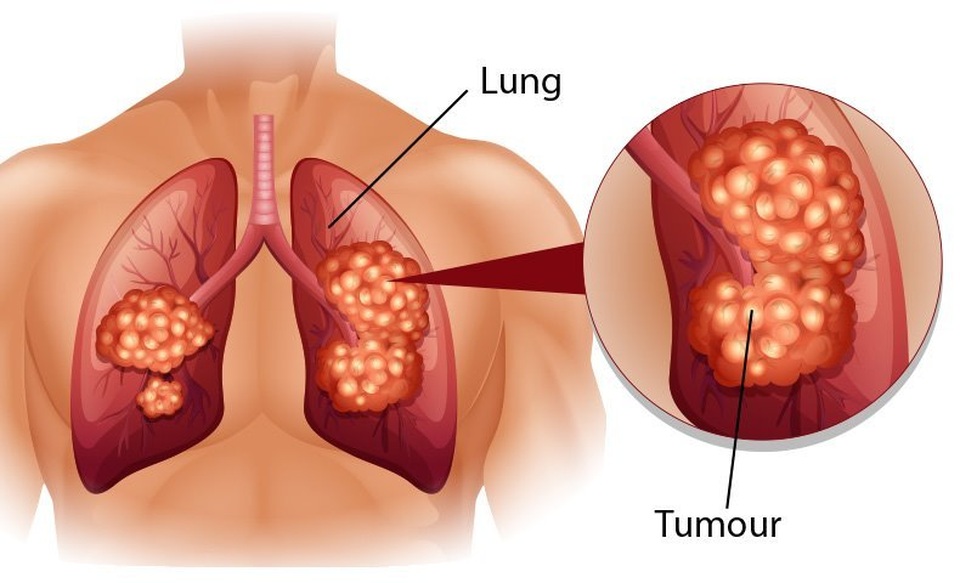 Những dấu hiệu cảnh báo loại ung thư gây chết người hàng đầu ở nam giới - 1 Những dấu hiệu cảnh báo loại ung thư gây chết người hàng đầu ở nam giới - 1