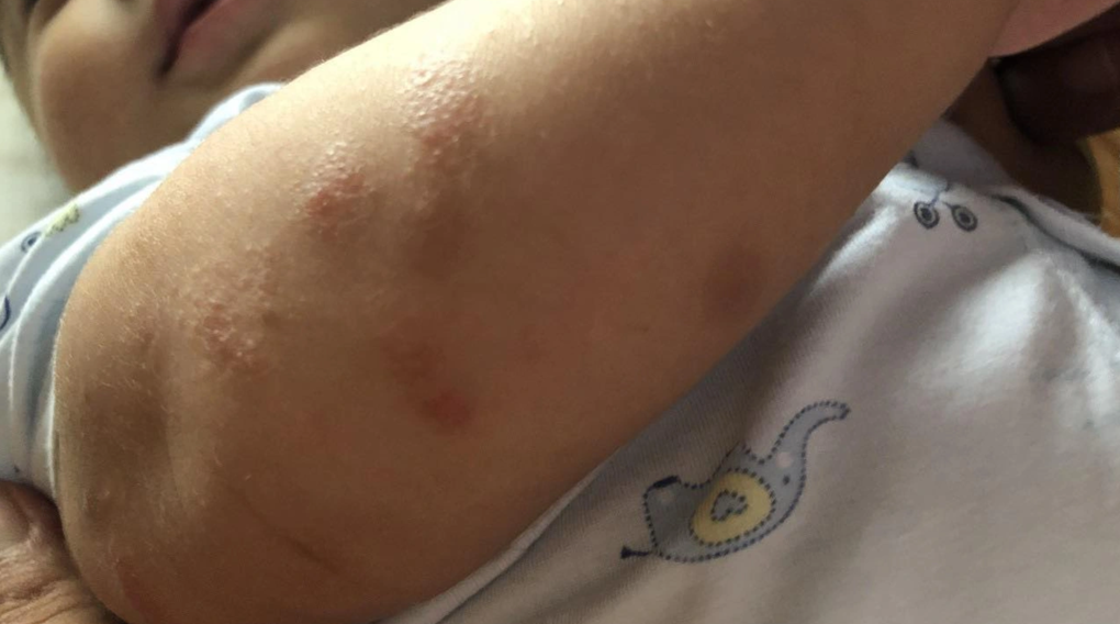 Khốn khổ trẻ nứt da, ngứa ngáy vì viêm da cơ địa mùa lạnh - 1 Khốn khổ trẻ nứt da, ngứa ngáy vì viêm da cơ địa mùa lạnh - 1