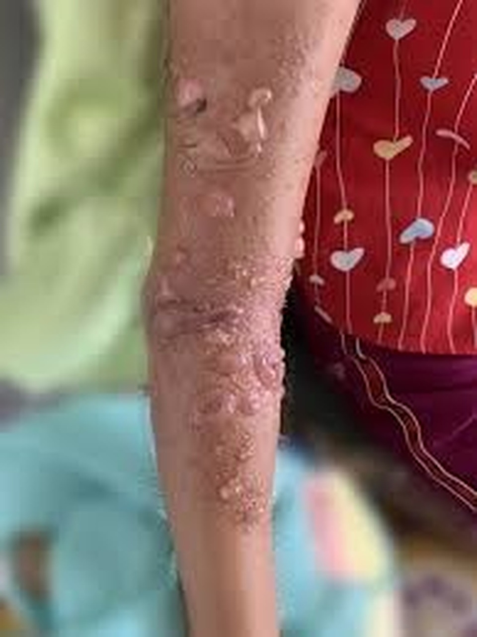 Biến đổi khí hậu khiến bệnh da liễu tăng cao - 1 Biến đổi khí hậu khiến bệnh da liễu tăng cao - 1