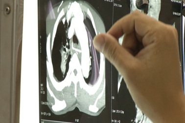 Ăn Tết bị hóc xương gà, cụ ông nguy kịch vì xương đâm thấu tim