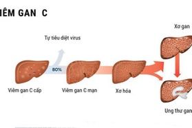 3 đường lây truyền phổ biến của viêm gan C
